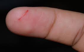 cut on finger (trauma)