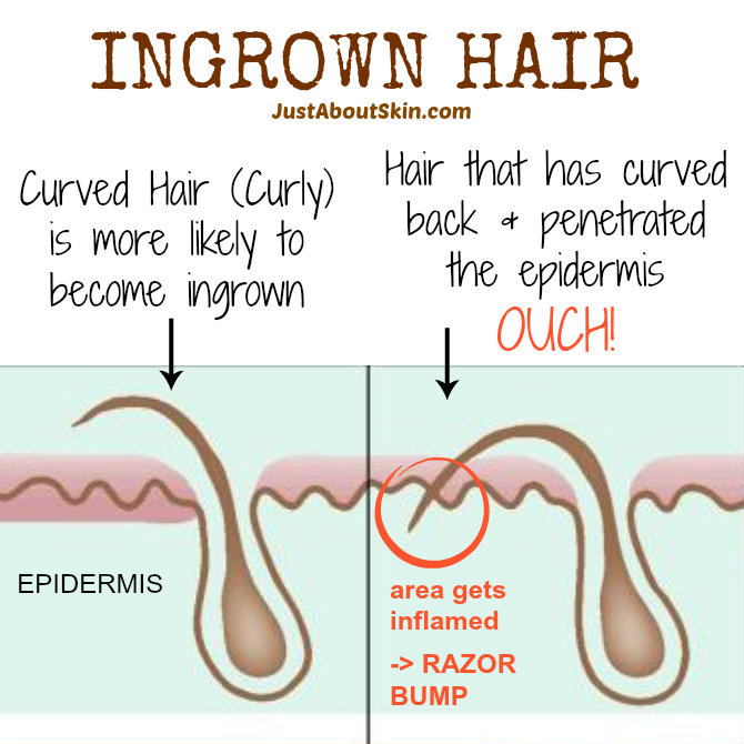 Tips for Preventing Ingrown Hairs - Just About Skin