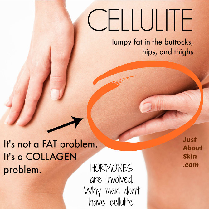 Cellulite, Causes & Treatment