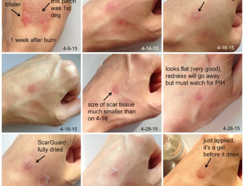 Burn Scar Treatment Case Study – How I Treated A Burn Scar With ScarGuard & Other Techniques